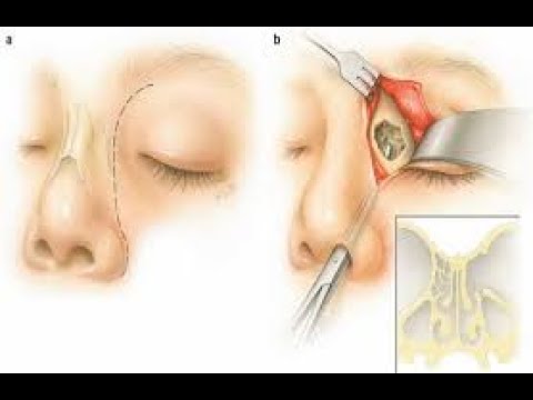 Ethmoidectomy CPT code - simplify medical coding
