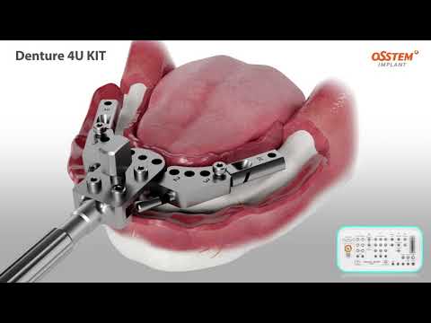 Denture 4U KIT Osstem