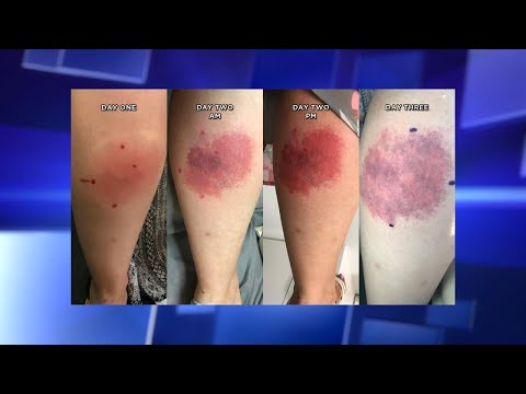 do crab spiders bite