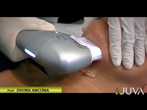 Come togliere lentiggini di faccia per sempre Violazione di pigmentazione di pelle questo