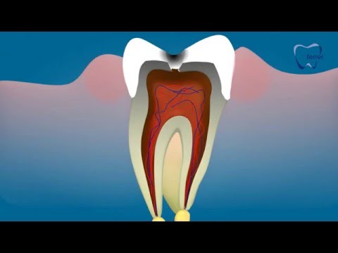 Caries