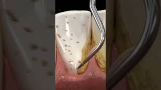 cleaning teeth with ultrasonic scaler #shorts