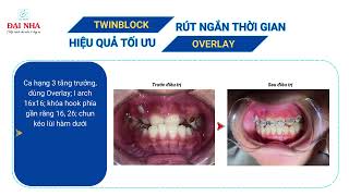 Chỉnh nha bằng Twinblock và Overlay hiệu quả và tiết kiệm thời gian như thế nào?