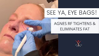 Treat Eye Bags Without Surgery!