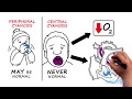 Hypoxia and Cyanosis: How to react when oxygen levels are low