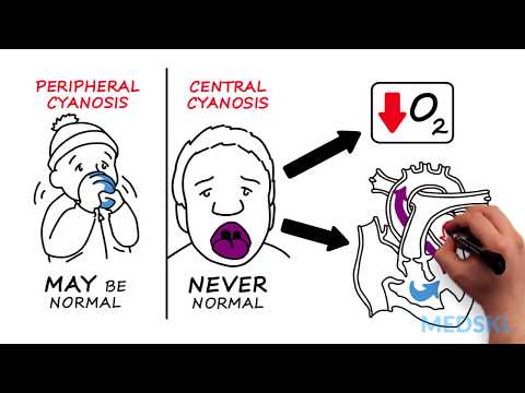 Hypoxia and Cyanosis: How to react when oxygen levels are low