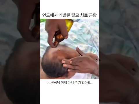 インドで開発された薄毛治療の近況