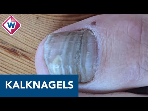 Kalknagels... en nu?