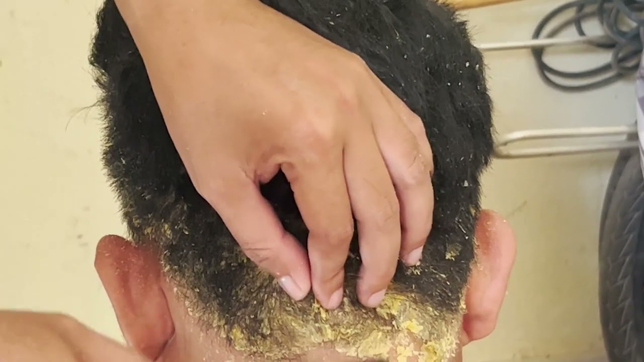 Big Flake In My Mother Hair !!  Many Dandruff Scratching Scalp 2