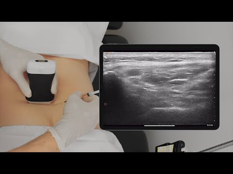 SI Joint PRP Injection