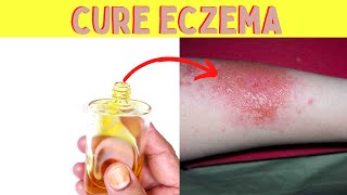 How to cure eczema fast and forever at home on face immediately   Cure Eczema