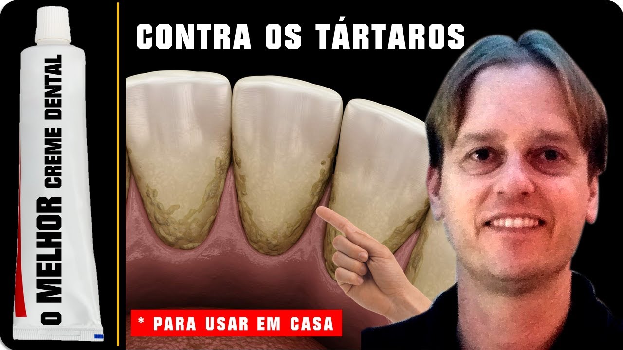 [Tártaro No Dente] - O MELHOR Creme Dental Contra Tártaro no Dente que Existe. (Para Usar em CASA!)