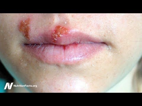 papilloma chirurgitron ürülék férgekkel