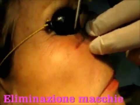 Il pigmentary nota su una faccia come liberarsi dopo la consegna da Togliere posti di pigmentary su una faccia Mosca