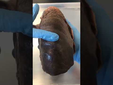 Rib Impressions on Human Lungs