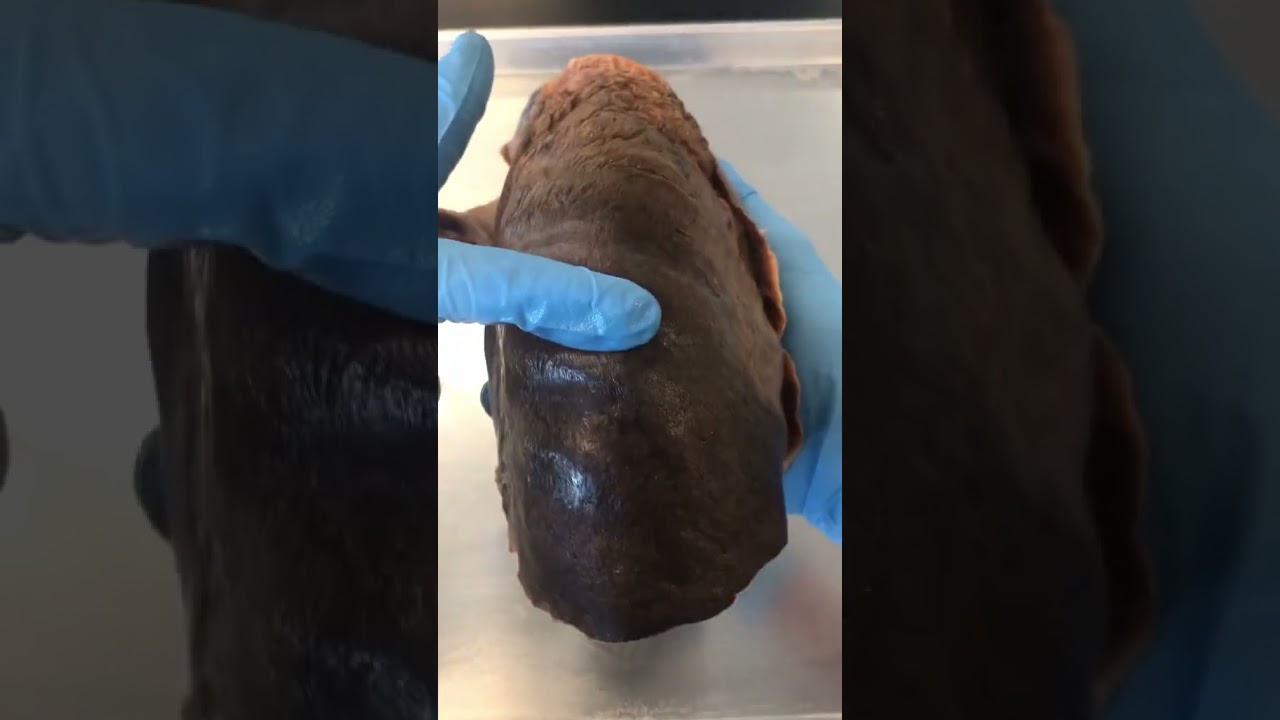 Rib Impressions on Human Lungs