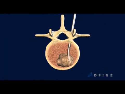 Fokus Behandlung Prostata Fibrose Entfernen von Fibrose in der Prostata