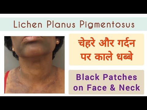 Allodermis video