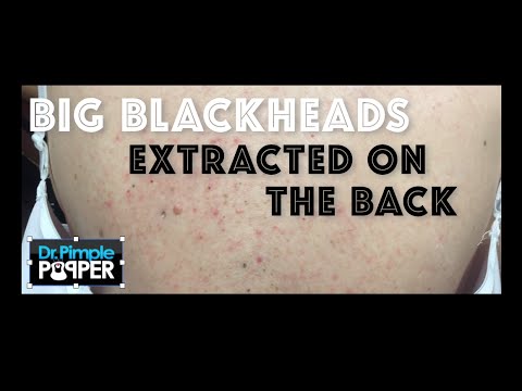 Re-introduction to Big Blackheads on the Back