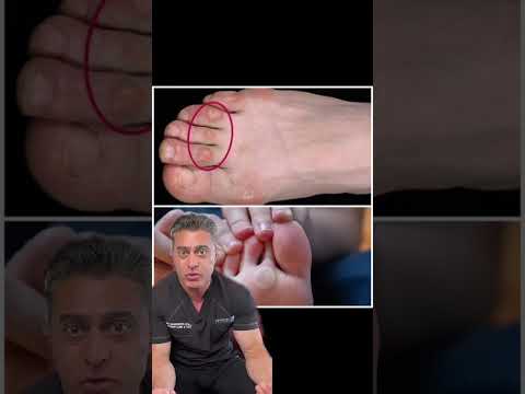 THIS Is How You Avoid Calluses? #feet