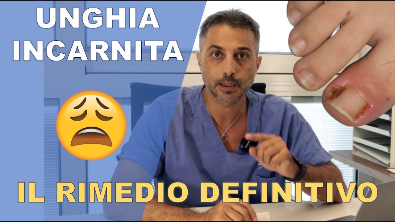 UNGHIA INCARNITA - Il rimedio DEFINITIVO