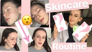 How I Cleared My Acne - Skincare Routine ♡ | Summer Xo