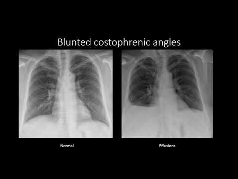 Pleural Effusions