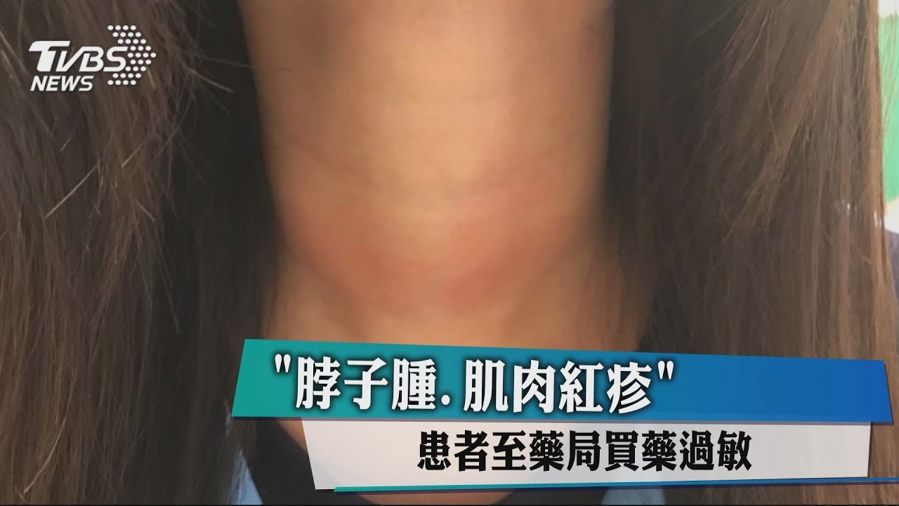 「脖子腫、肌肉紅疹」　患者至藥局買藥過敏