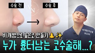 비개방코성형 성형외과전문의가 직접 알려주는 핵심 포인트