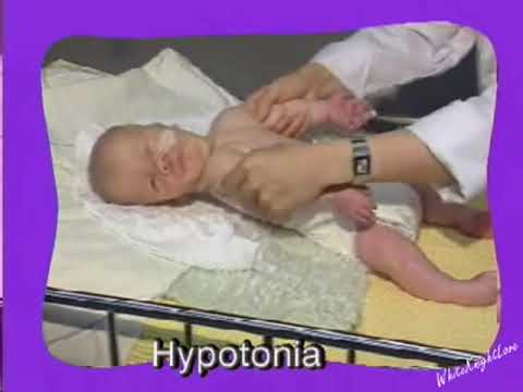 Exemplo de Hipotonia