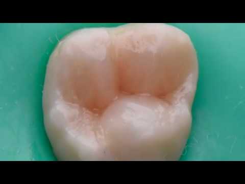 CCC - Dr. Alberto Pereira - Restauración Directa con Brilliant EverGlow