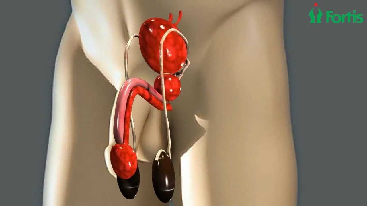 Urethral Stricture : Buccal Mucosal Graft Process, Fortis Healthcare.