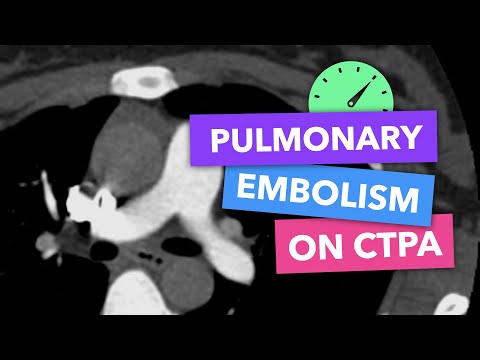 Pulmonary embolism on CTPA - Radiopaedia's Emergency Radiology Course