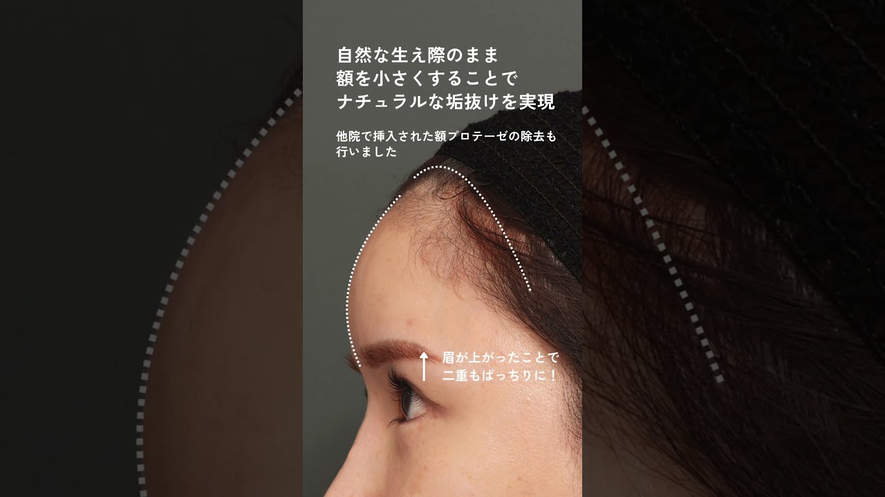 【術後1ヶ月 / #額縮小 プロテーゼ除去】🔻解説はキャプションをチェック👀　#shorts