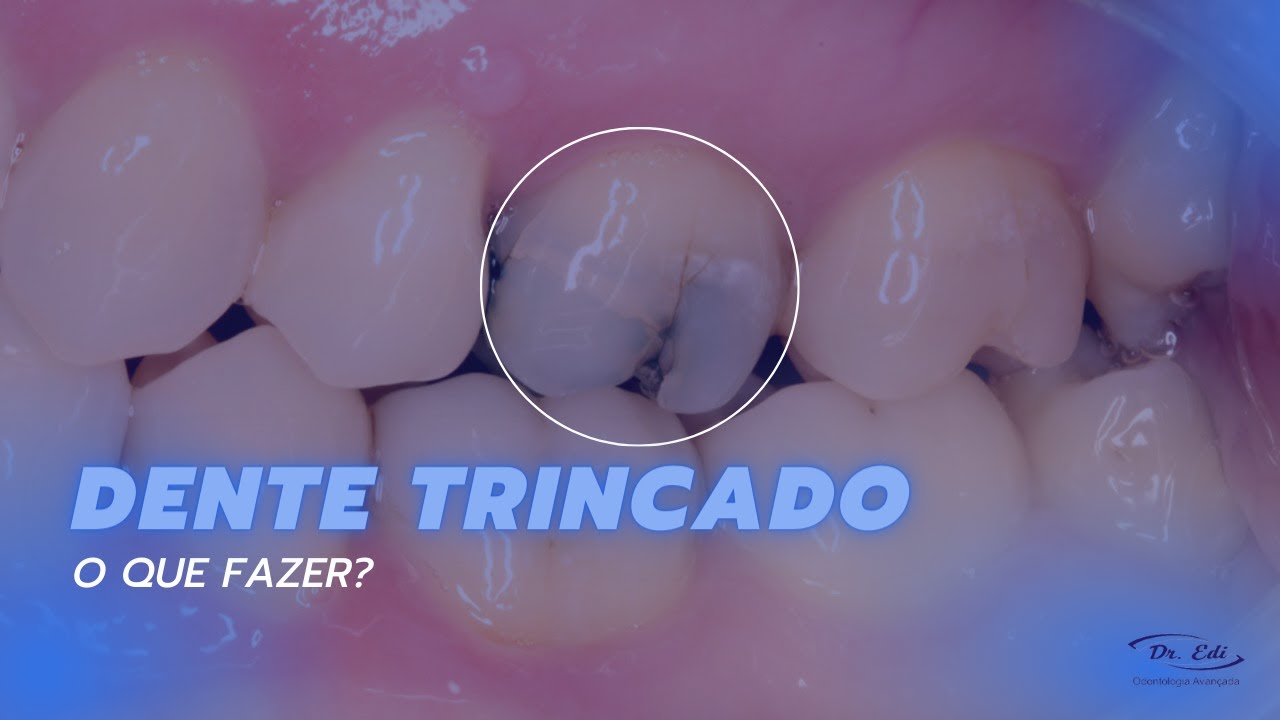 Dente trincado, o que fazer? veja as causas e tratamentos!