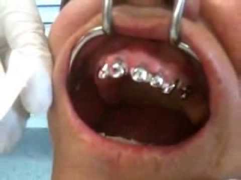 Teleskoparbeit mit 5 Teleskopen in 4 Min mit ZemFix® einsetzen! (Live! Ungeschnitten!)