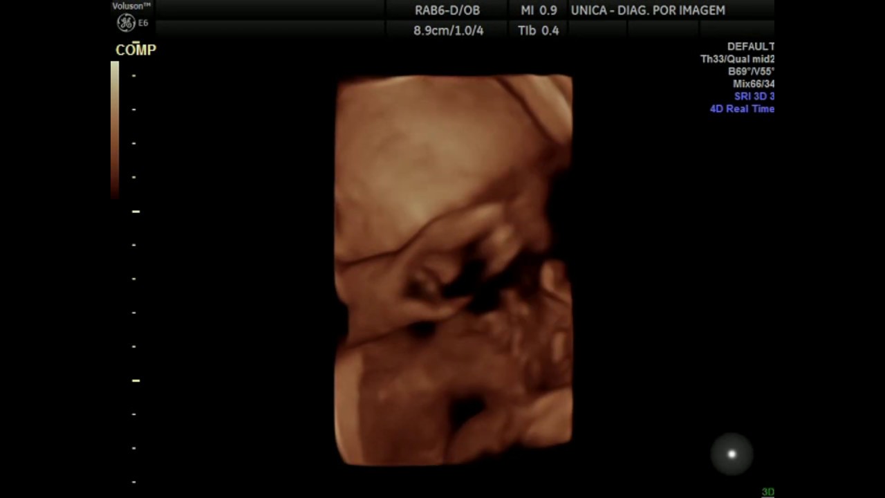 Ultrassom 4D HD LIVE