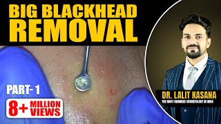 BIG BLACKHEAD REMOVAL Part- 1