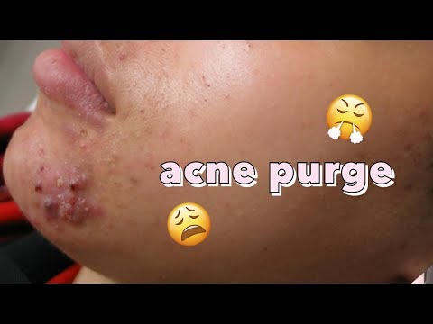 Skin Purging | Does Acne Have to Get Worse Before It Gets Better?