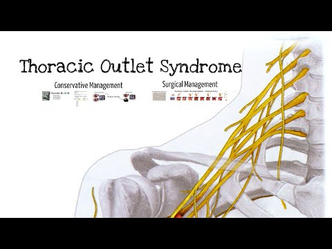 Thoracic-outlet-Syndrome