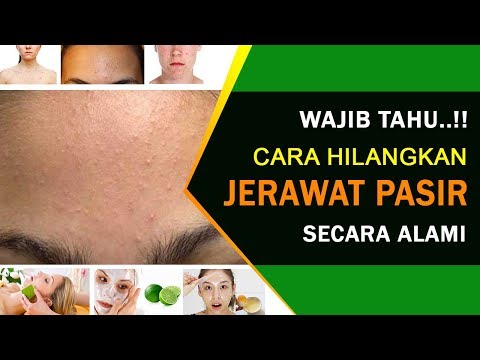 download video viral Cara Menghilangkan Jerawat Pasir Dengan Bawang Putih, download Cara Menghilangkan Jerawat Pasir Dengan Bawang Putih gratis, unduh video Cara Menghilangkan Jerawat Pasir Dengan Bawang Putih