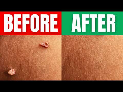 The Secret To Removing Skin Tags And Warts Overnight