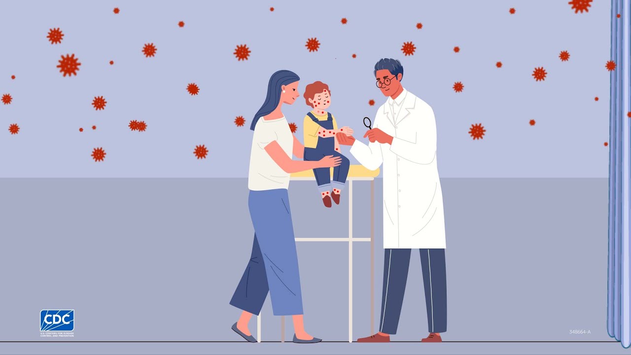 
Measles is very contagious CDC