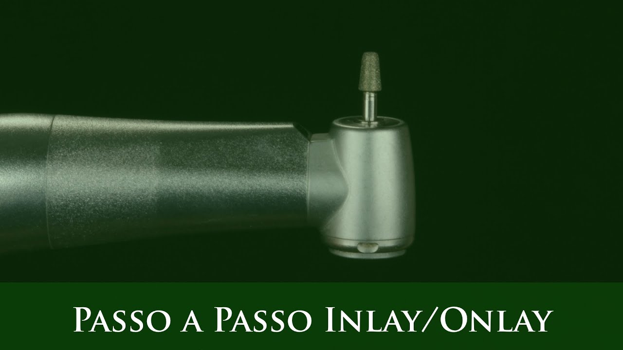 Passo a passo de preparos dentais para Inlay e Onlay.