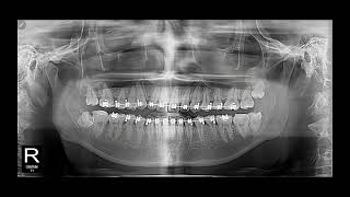 Tip lâm sàng đóng khoảng răng hàm