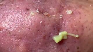 Removing pus from juicy pimples || GoPimple