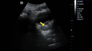 Prostatic calcification | Ultrasound Case