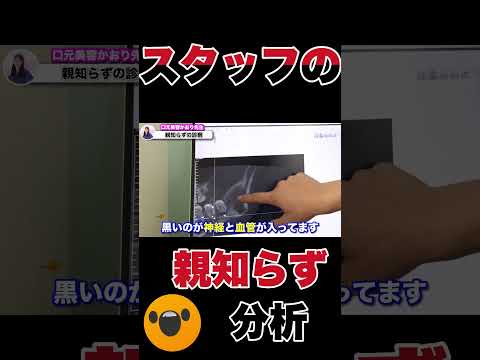 危険度の高い親知らずって？町の歯医者で抜けない親知らずとは…？