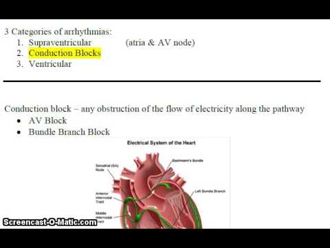 Conduction Block Arrhythmias