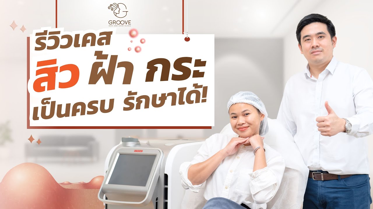 รีวิวรักษาฝ้า กระ จุดด่างดำ